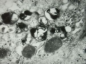 M,8y. | Wilson disease susp.